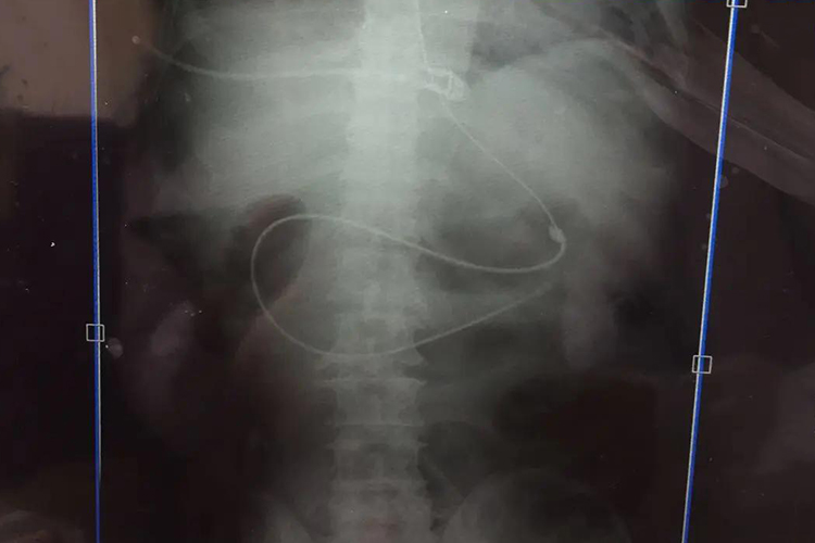 X线引导下放置鼻空肠管图