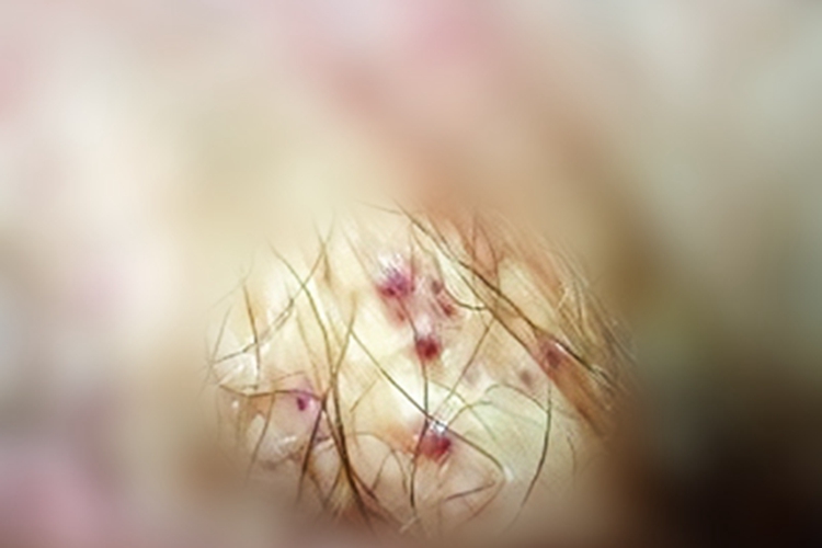 阴囊血管角化瘤疙瘩图 阴囊血管角化瘤疙瘩图