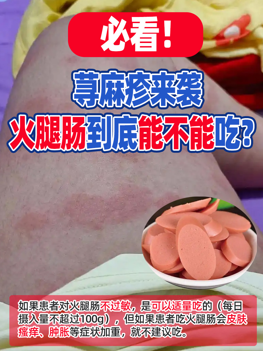 必看！荨麻疹来袭，火腿肠到底能不能吃？