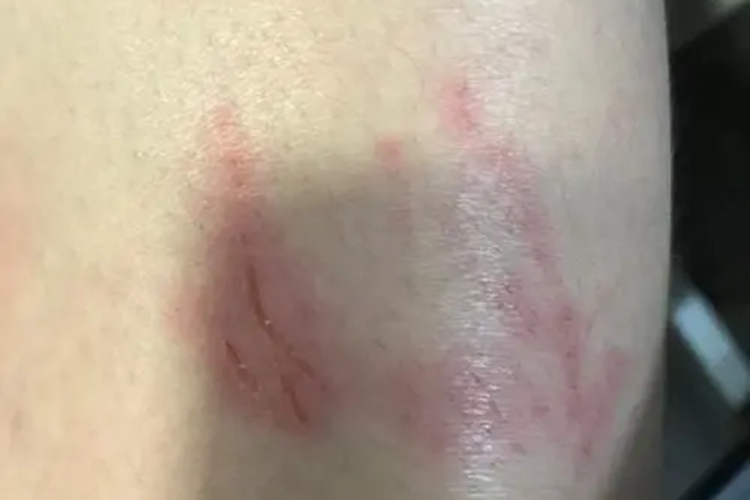 指甲抓痕红肿图