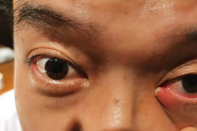 结膜面囊肿破溃图