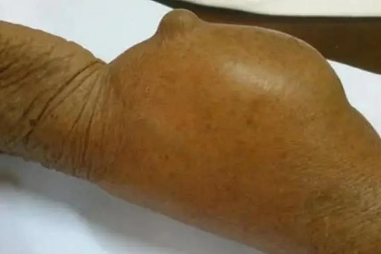 骨癌长刺局部肿块图