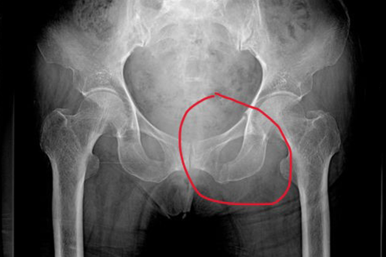 耻骨联合骨折图片