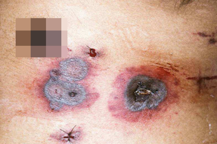 镰刀菌病胸部症状图