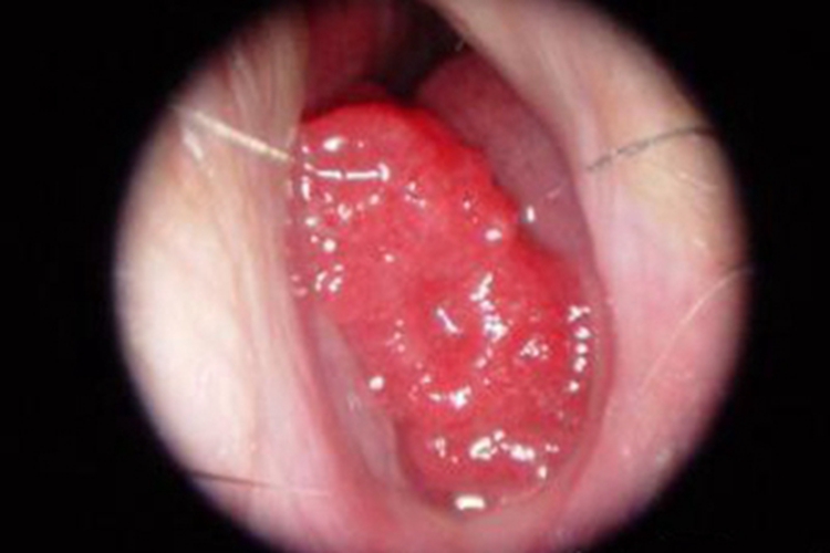 慢性化脓性鼻窦炎鼻腔息肉图