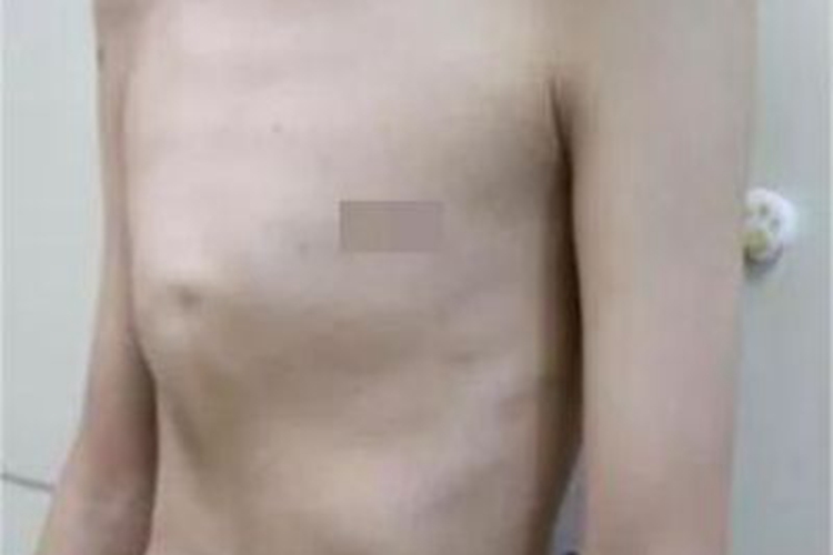 鸡胸胸骨很突出图 鸡胸胸骨很突出图