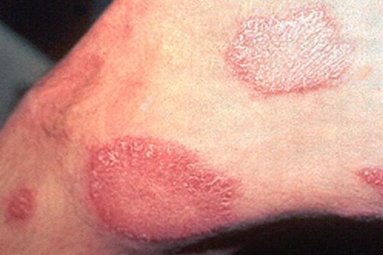 界限类偏结核样型麻风大腿症状图