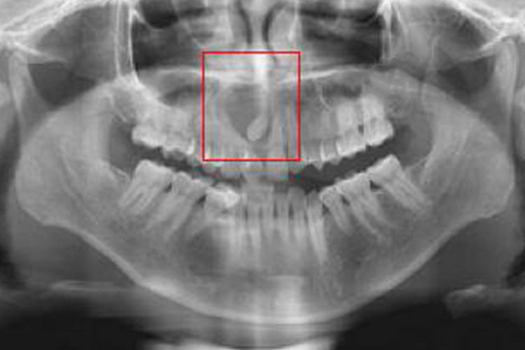 牙源性腺样瘤X线图