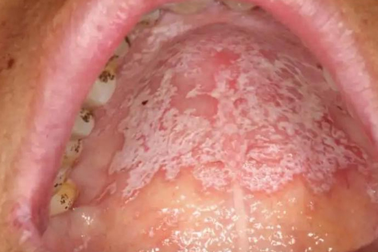 HIV口腔念珠菌感染白色假膜图
