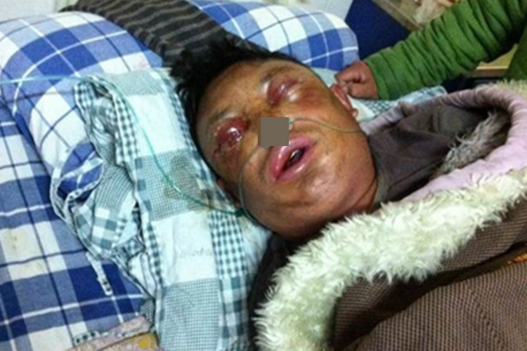 炭疽病面部症状图