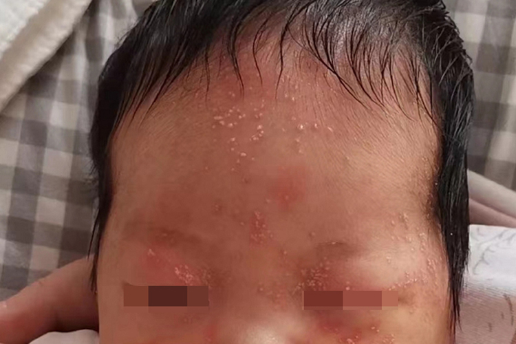 三个月宝宝头上渗出性湿疹图 三个月宝宝头上渗出性湿疹图