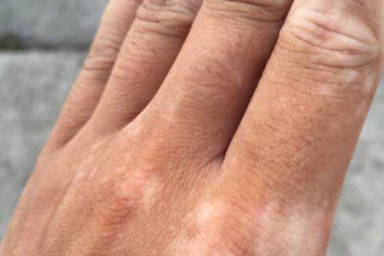 手部白癜风白斑图