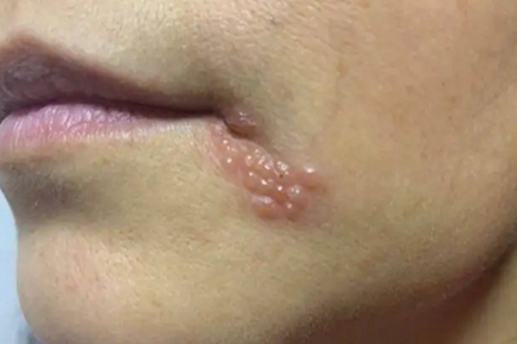 口腔疱疹口周水疱图 口腔疱疹口周水疱图