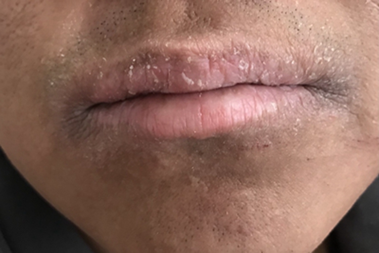 剥脱性唇炎嘴唇干燥颜色暗沉图