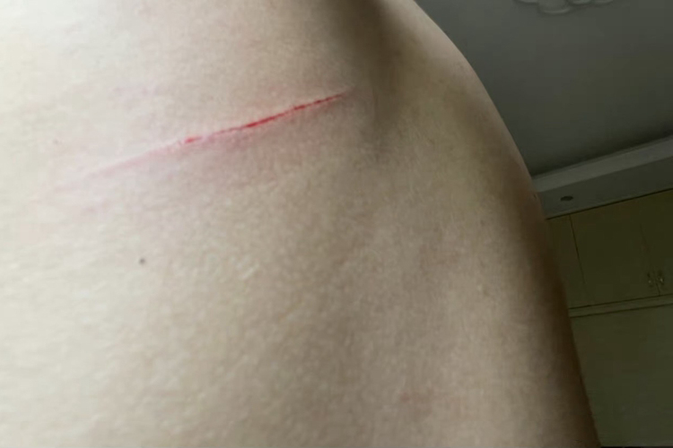 背上切割伤伤口图