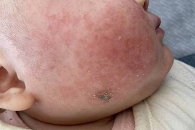 亚急性湿疹脸上有红点图