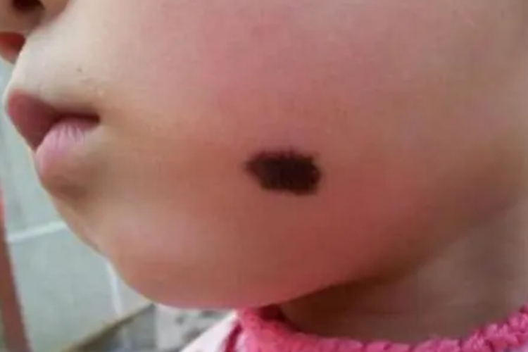 黑毛痣图 黑毛痣图