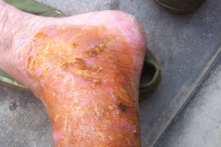 静脉曲张性溃疡出现黄痂图 静脉曲张性溃疡出现黄痂图