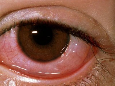 泪腺炎可造成白眼球处明显充血,肿大,还可以使眼睛发红,会在白眼球