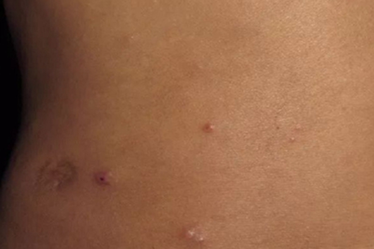 瘤型麻风腰部症状图 瘤型麻风腰部症状图