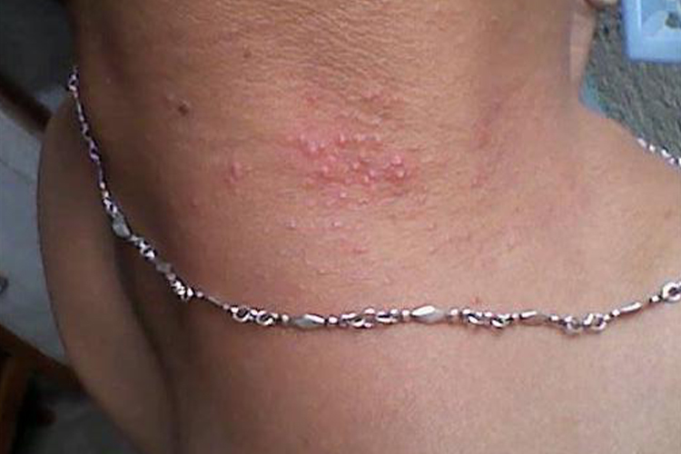 男性颈部尖锐湿疣初期图