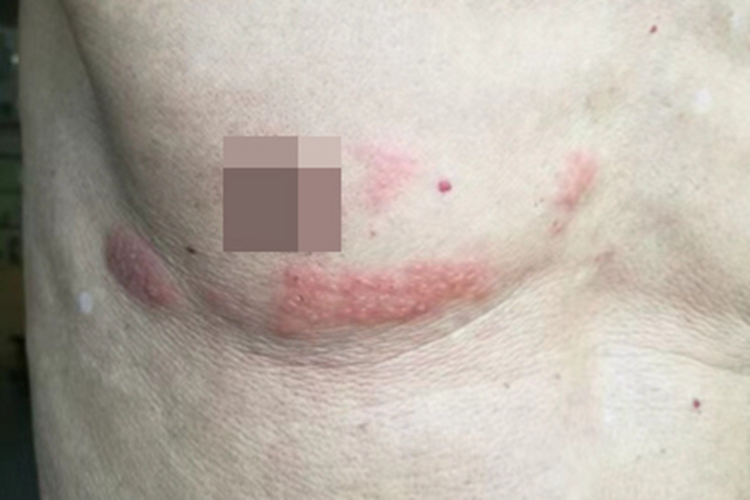 带状疱疹胸部症状图