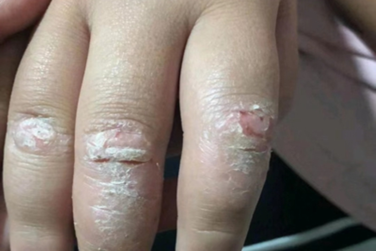 慢性湿疹皲裂图 慢性湿疹皲裂图