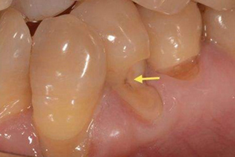 楔状缺损牙齿缺一块图