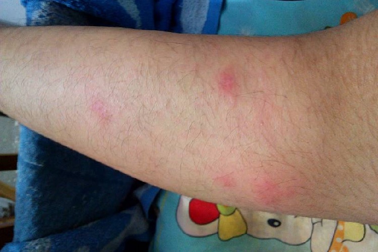 棘球蚴病小腿大红疙瘩图