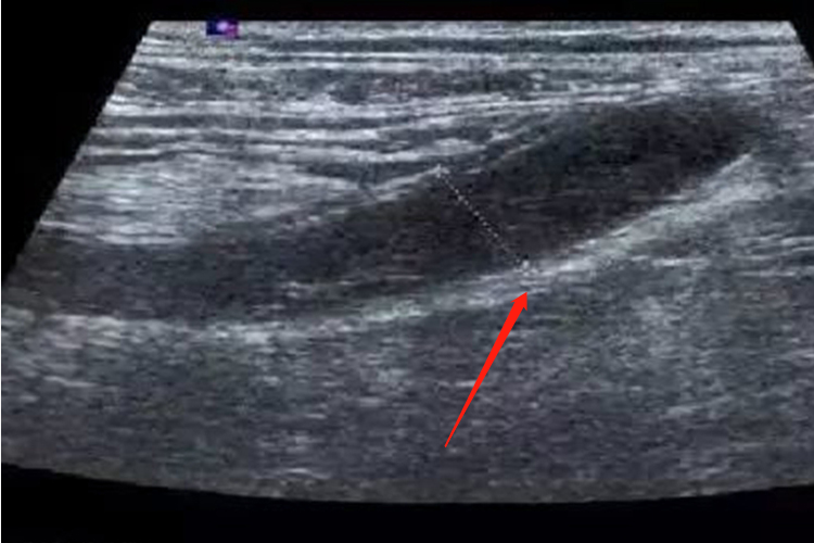 阑尾炎超声检查图