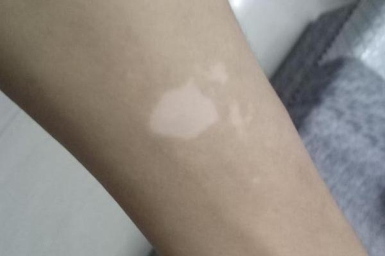 手臂白癜风图 手臂白癜风图