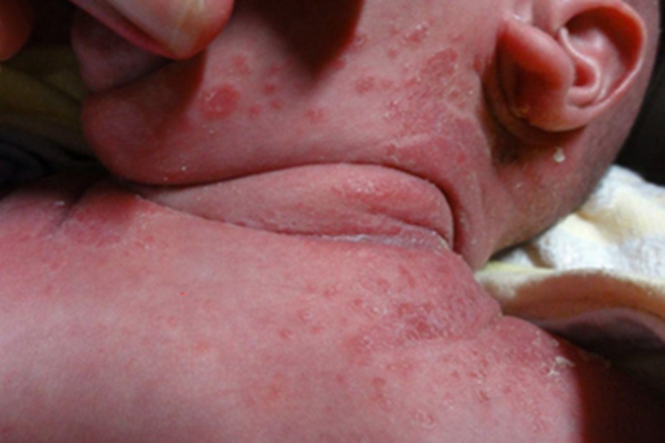 念珠菌性间擦疹侧颈小红疙瘩图