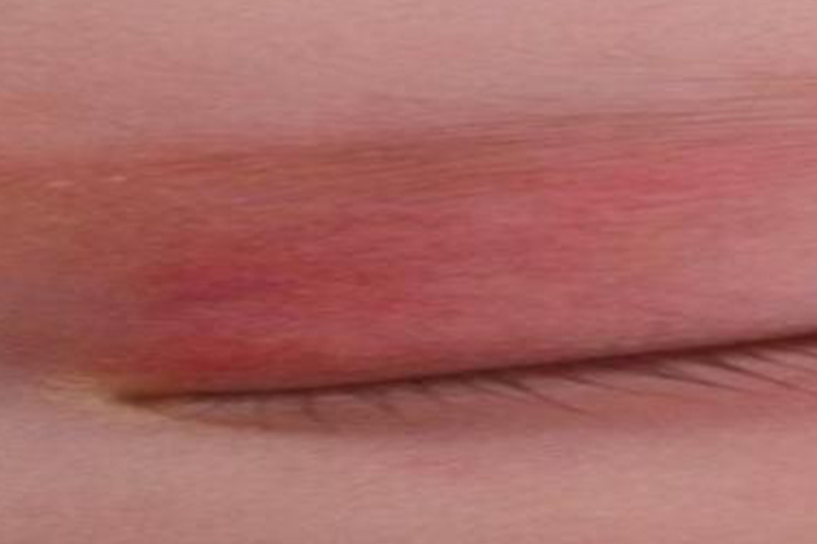 婴儿鲜红斑痣图