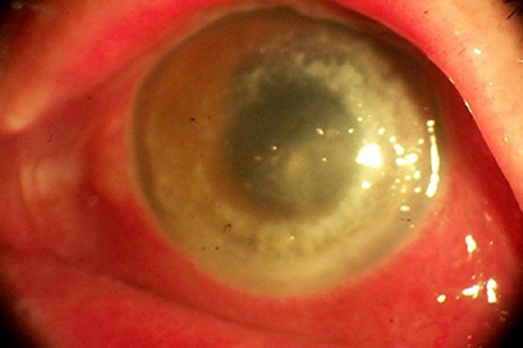 男性二期梅毒眼球红肿图