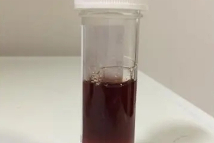 溶血血红蛋白尿图