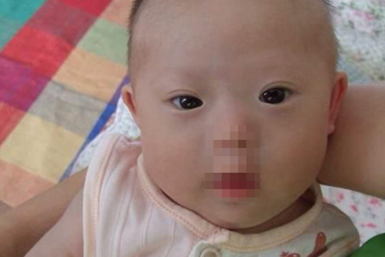 唐氏综合征面容图 唐氏综合征面容图