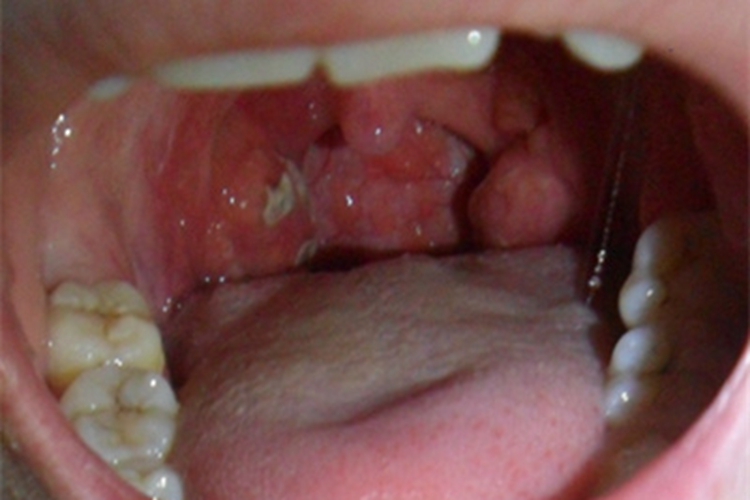 传染性单核细胞增多症咽喉溃疡图