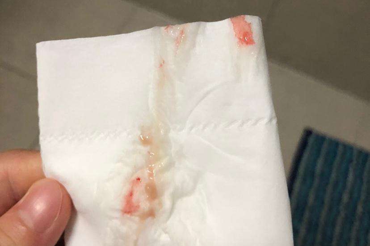 先兆临产分泌物带血丝图