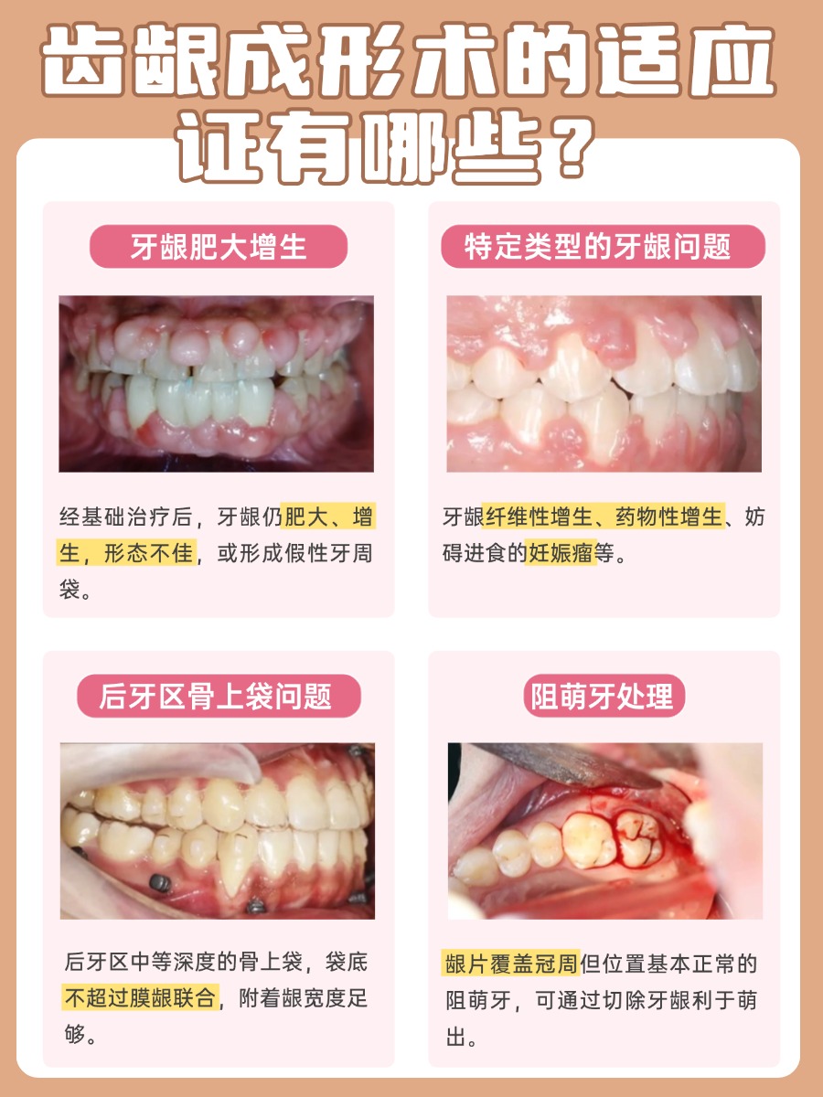 一文读懂：齿龈成形术究竟是什么？