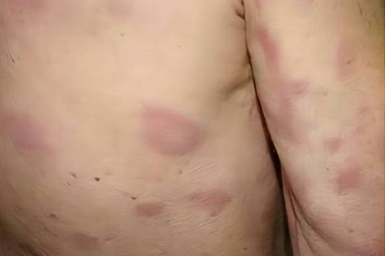 中间界线类麻风红斑图