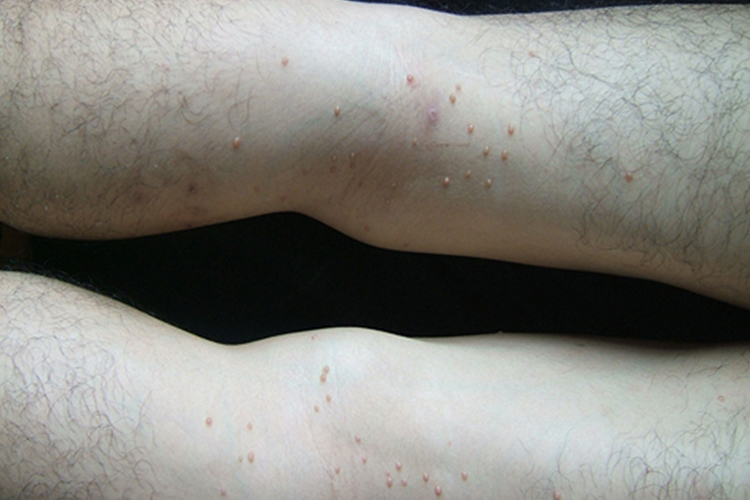 腿部传染性软疣图