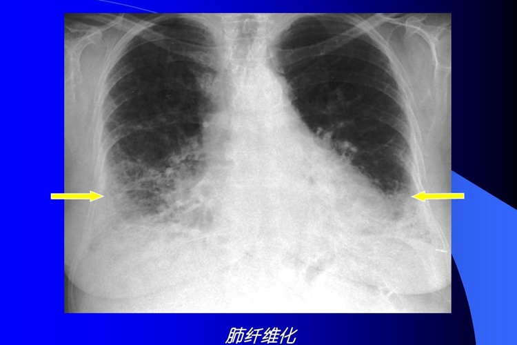 肺纤维化CT图 肺纤维化CT图