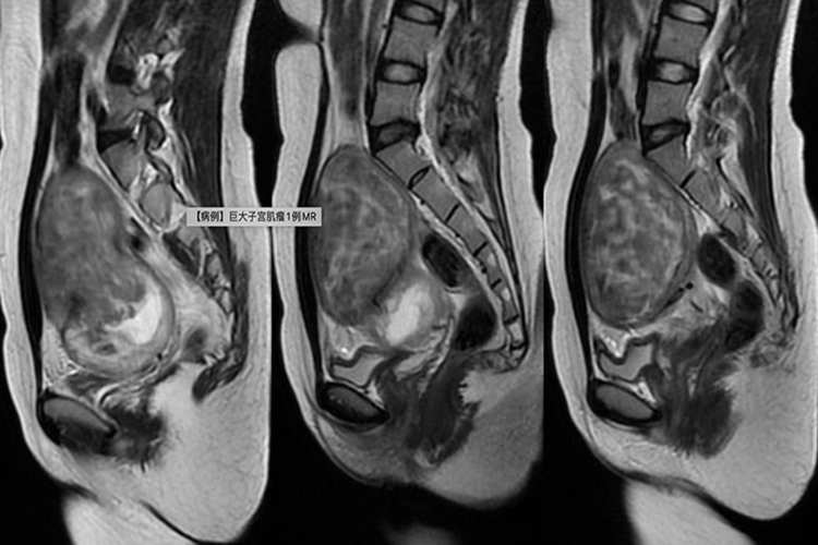 子宫肌瘤图 子宫肌瘤图