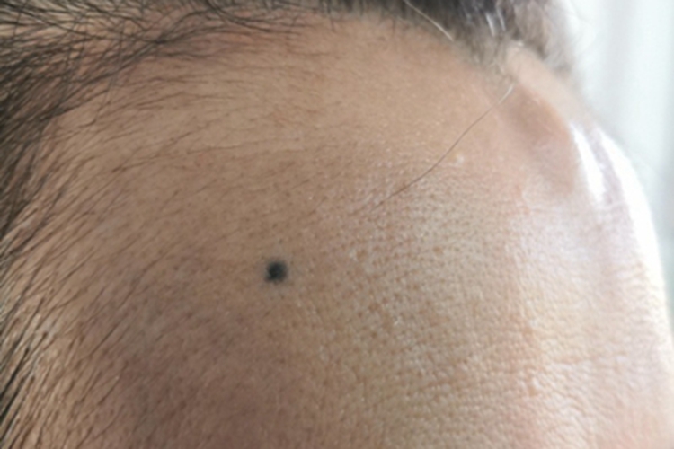 交界痣额头有个黑痣图 交界痣额头有个黑痣图