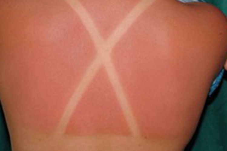 日光性皮炎背部红斑图