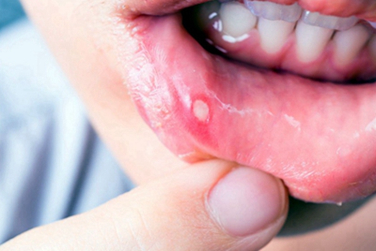 轻型阿弗他溃疡图