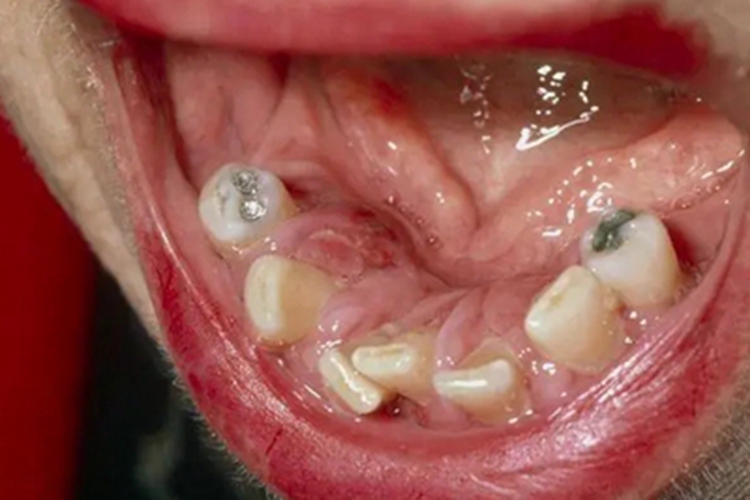 三期口腔梅毒牙龈糜烂图片