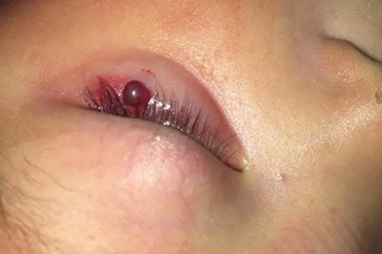 化脓性肉芽肿眼睑丘疹图