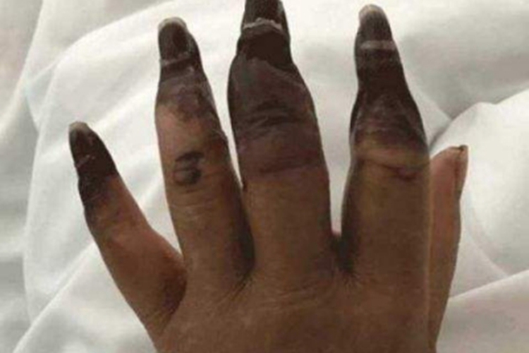 干性坏疽手指症状图 干性坏疽手指症状图