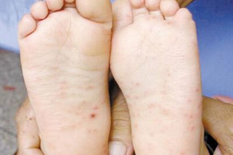 手足口病足部丘疹图
